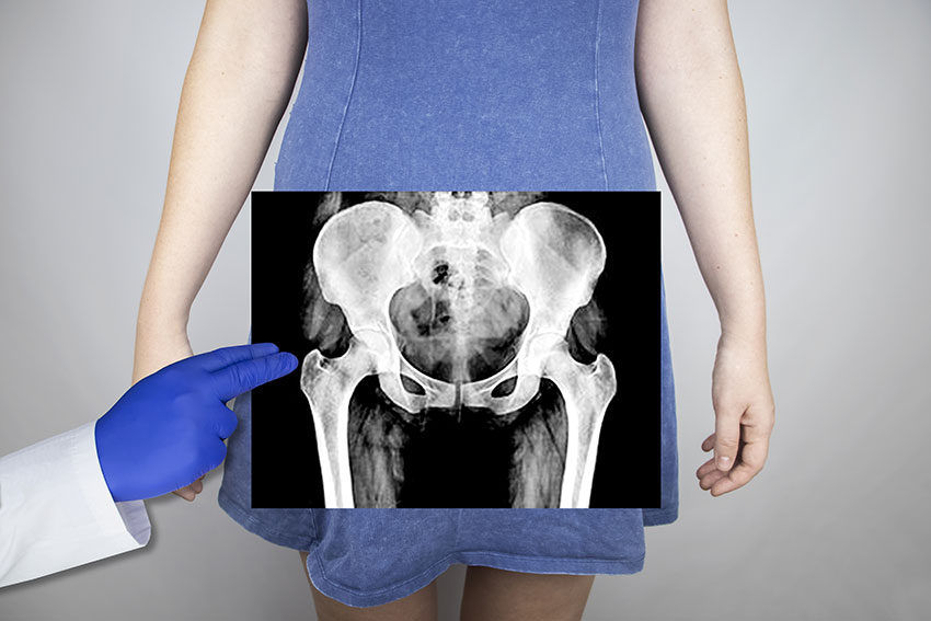 Pelvic xray