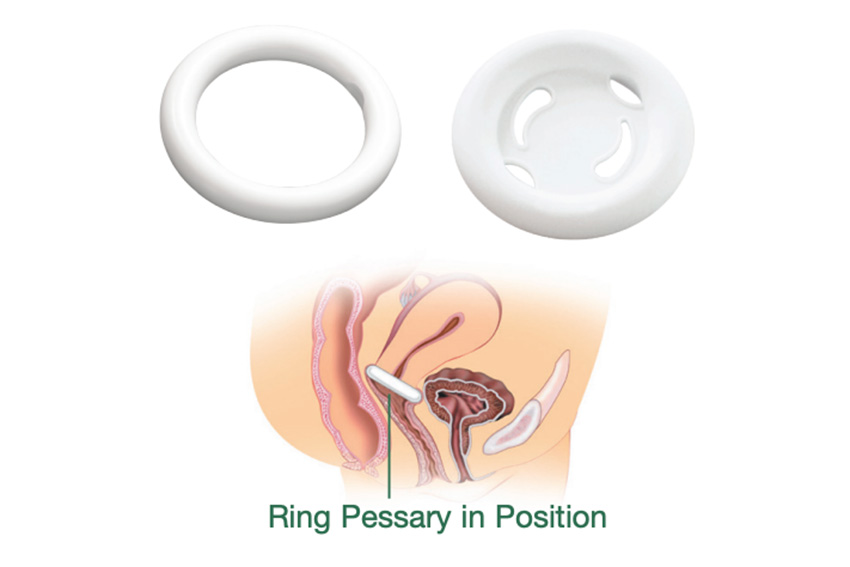 Pessary Fitting